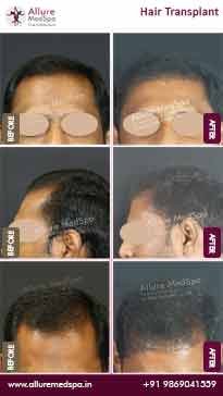 Hair-Transplant-Before-and-After-Result