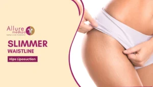 Hip Liposuction 300x170 1