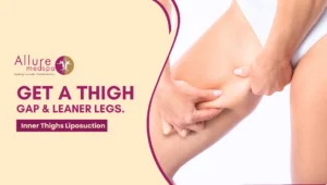 Inner Thigh Liposuction 300x170 1