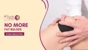 Knees Liposuction 300x170 1