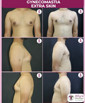 Gynecomastia Surgery Cost 9 LARGE-GYNAECOMASTIA-WITH-EXTREA-SKIN-SCARLESS-MALE-BREAST-REDUCTION-SURGERY-RESULT-COST