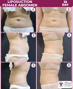 LIPOSUCTION-FEMALE-ABDOMEN