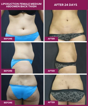 LIPOSUCTION-FEMALE-MEDIUM-ABDOMEN-BACK-THIGH
