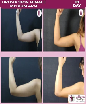 Liposuction-female-medium-arm_10day