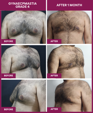 Gynecomastia Surgery Cost 16 Male-Breast-Reduction-Surgery-Result-Mumbai-India (1)