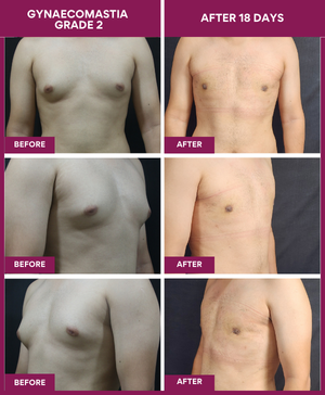 Gynecomastia Surgery Cost 15 Male-Breast-Reduction-Surgery-Result-before-after-image (1)