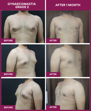 Gynecomastia Surgery Cost 13 Male-Breast-Reduction-Surgery-Result-image (1)