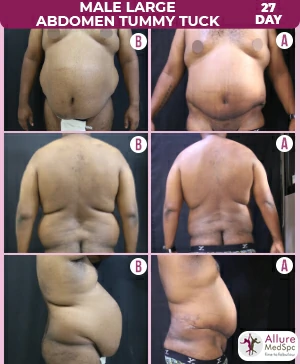 Tighten Your Abs with a Mini Tummy Tuck for Active, Fit Moms 8 Male_Large_Abdomen_Tummy_Tuck (1)