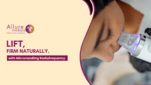 Microneedling Radiofrequency 300x170 1