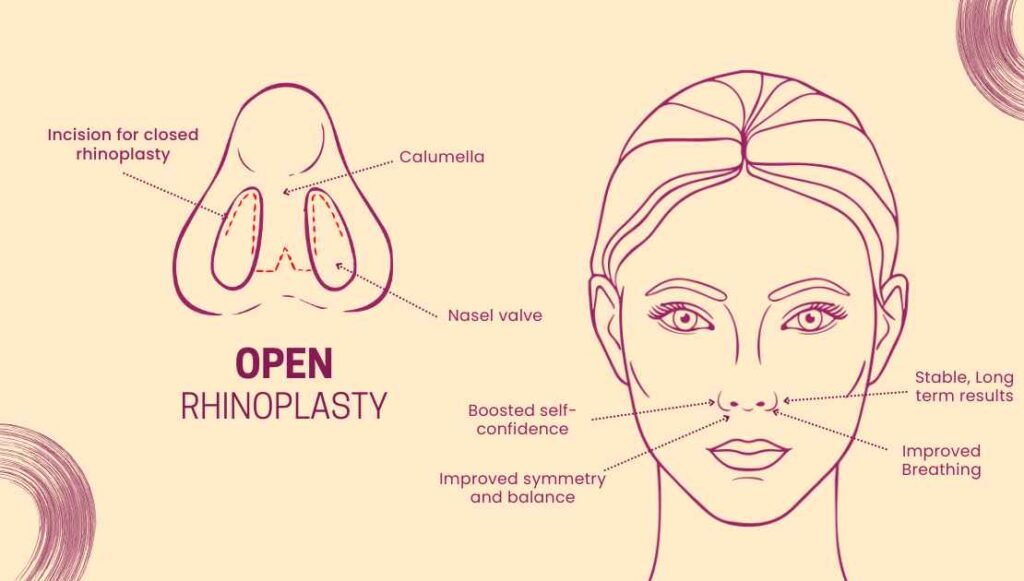 Open Rhinoplasty: Precision Technique for Natural & Balanced Results
