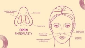Open Rhinoplasty