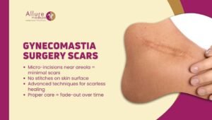 Gynecomastia Scars After Surgery_ Prevention, Treatment & Reality