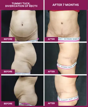 Tighten Your Abs with a Mini Tummy Tuck for Active, Fit Moms 9 TUMMY-TUCK-DIVERICATION-OF-RECTII (1)