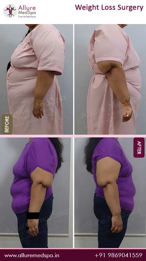 Bariatric Surgery 3 Weight-Loss-Before-and-After-Images-in-Mumbai-India