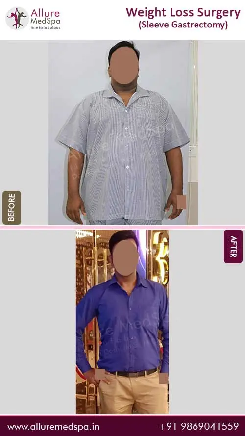Bariatric Surgery 2 Weight-Loss-Surgery-Before-and-After-Gallery-in-Mumbai-India