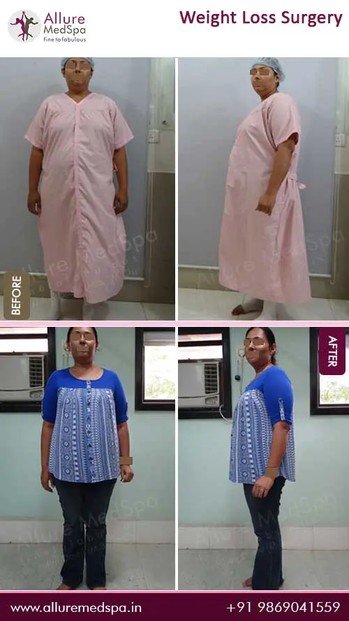 Bariatric Surgery 13 Weight-Loss-Surgery-Before-and-After-Images-in-Mumbai-India