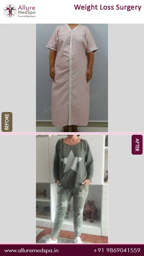 Bariatric Surgery 12 Weight-Loss-Surgery-Before-and-After-Photos-in-Mumbai-India