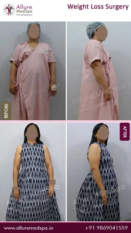 Bariatric Surgery 11 Weight-Loss-Surgery-Before-and-After-Pictures-in-Mumbai-India