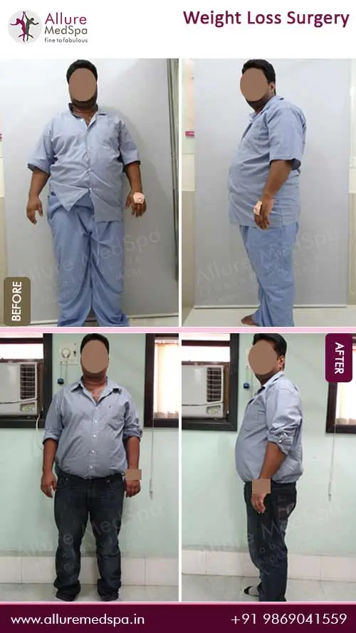 Bariatric Surgery 10 Weight-Loss-Surgery-Before-and-After-Result-in-Mumbai-India
