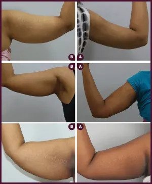 Arm Liposuction Before & After Image