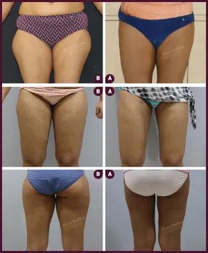 Thigh Liposuction Before & After Image