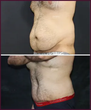 Tummy Tuck Surgery Cost 5 2019-11-040-MALE-SMALL-ABDOMEN-TUMMY-TUCK-2