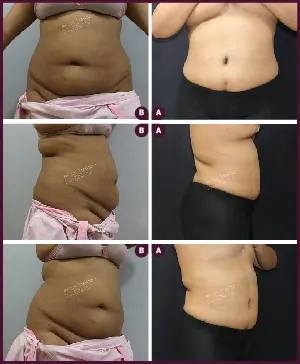 Tummy Tuck Surgery Cost 6 ABDOMINOPLASTY-01-2