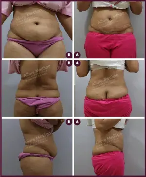 Tummy Tuck Surgery Cost 7 ABDOMINOPLASTY-05-1