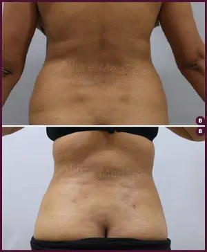 Allure_Liposuction_Back_Fat_Female_2021-2