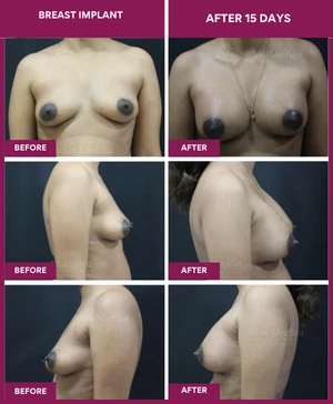 Breast Augmentation Cost 6 BREAST-IMPLANT0-after-15-days
