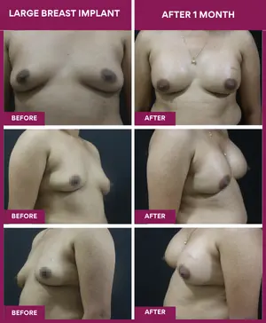 Breast Augmentation Cost 4 Breast-Implant-Augmentation-Surgery-Result