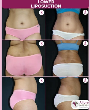 FEMALE-MEDIUM-ABDOMEN-HOURGLASS-RESULT-IMAGES-TUMUSCENT-AND-VASER-LIPOSUCTION-SURGERY-COST-2