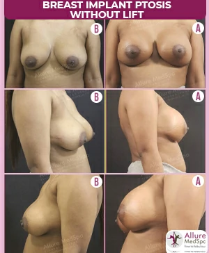 Breast Augmentation Cost 8 Implant-surgery-in-ptotic-breast-without-lift