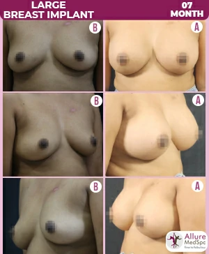 Breast Augmentation Cost 16 LARGE-BREAST-IMPLANT