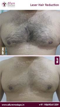 Laser-Hair-Reduction-Before-and-After-Gallery