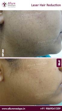 Laser-Hair-Reduction-Before-and-After-Result