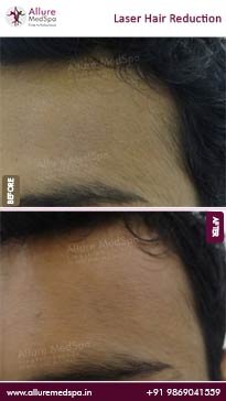 Laser-Hair-Reduction-Treatment-Before-and-After-Pictures