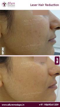 Laser-Hair-Removal-Before-and-After-Gallery-1