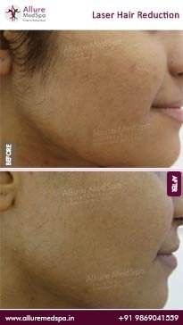 Laser-Hair-Removal-Before-and-After-Images-1