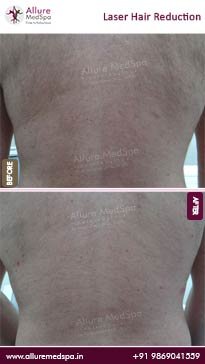 Laser-Hair-Removal-Before-and-After-Result-1