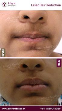 Laser-Hair-Removal-Treatment-Before-and-After-Pictures