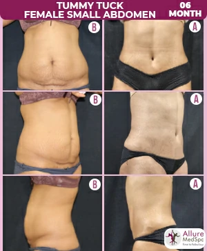 Tummy Tuck Surgery Cost 4 Tummy-Tuck-Female-small-abdomen
