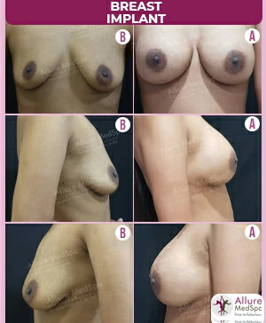 Breast Augmentation Cost 10 dual-plane-smooth-Breast-Implant-surgery-result-and-cost