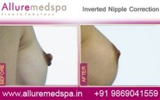 Inverted Nipple Correction Surgery 2 inverted-nipple-correction-before-and-after-gallery-mumbai-india