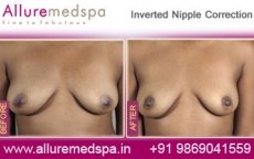 Inverted Nipple Correction Surgery 3 inverted-nipple-correction-before-and-after-photos-mumbai-india