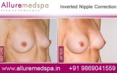 Inverted Nipple Correction Surgery 4 inverted-nipple-correction-before-and-after-pictures-mumbai-india