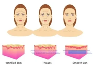 Areas treated with threadlift in Mumbai, India