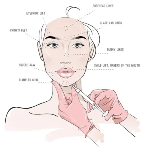Common Treatment Areas for Dermal Fillers in Mumbai, India
