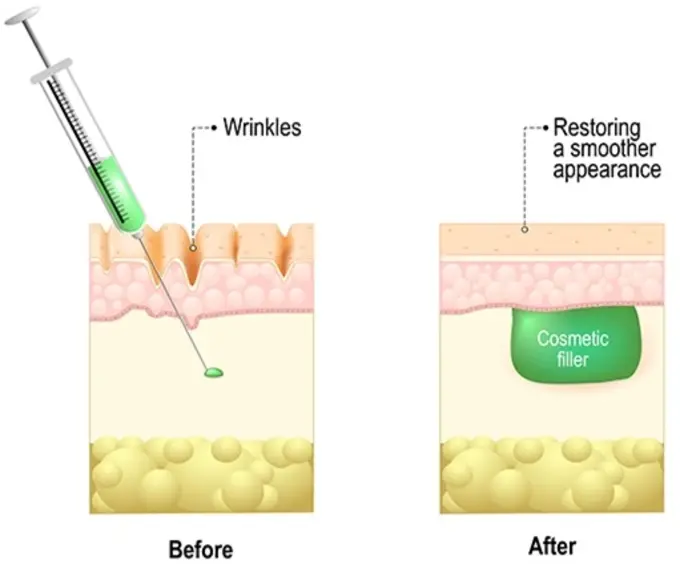 Derma Fillers Fat Grafting in Mumbai, India
