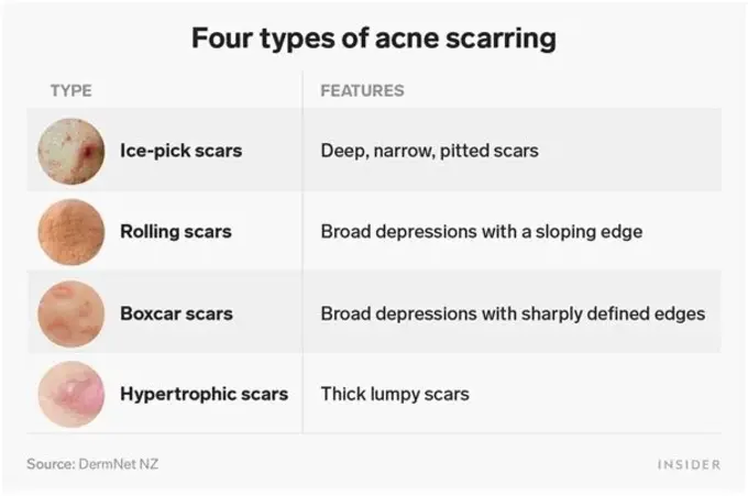 Acne Treatment 11 Four Types of Acne Scarring in Mumbai, India